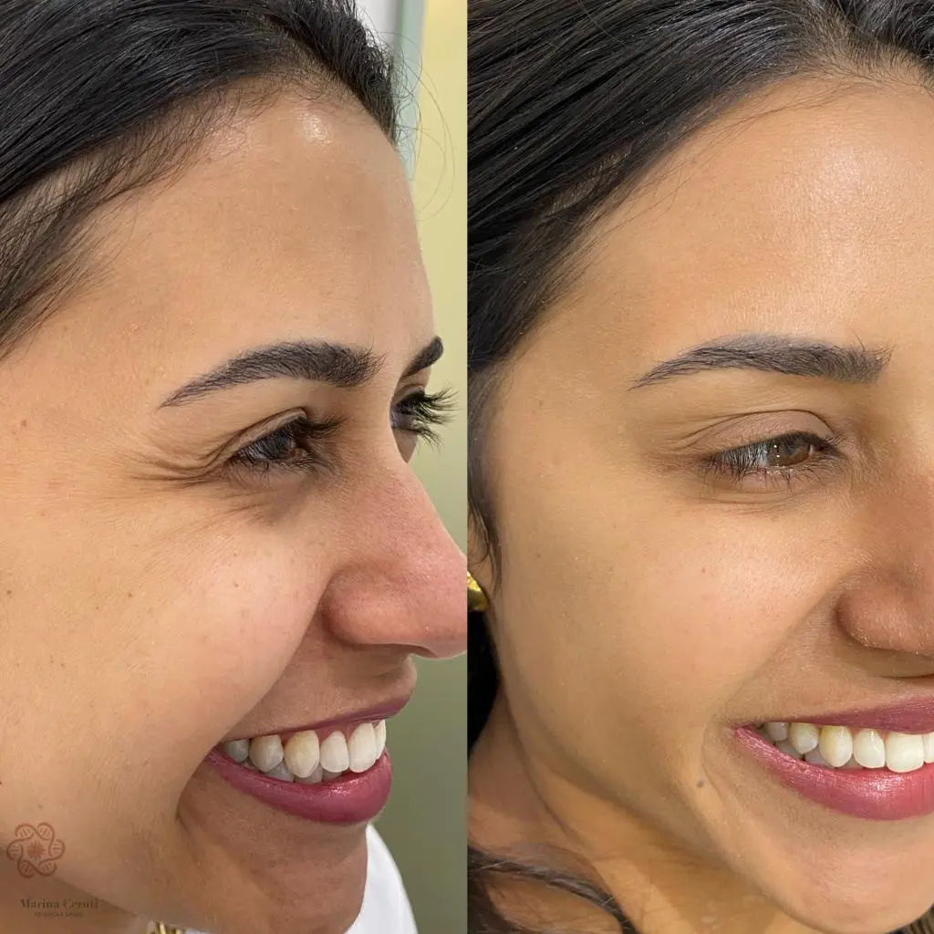 Resultado 4 - Suavização de linhas finas